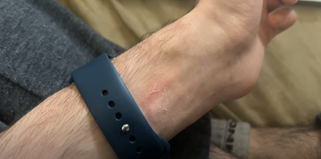 a man wearing a smartwatch with a rash on his wrist